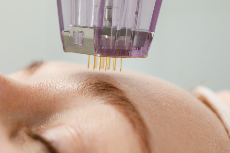 Microneedling vs. RF Microneedling: What’s the Difference and Which Is Right for You?
